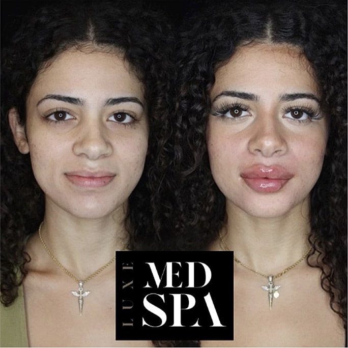 Before and after beauty treatment comparison photo.